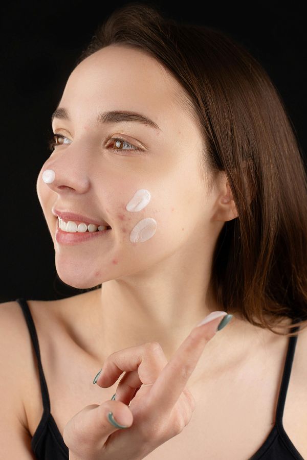 mujer con crema y espinillas en rostro sonriente