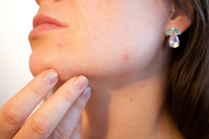 Maskné: qué es, por qué aparece el acné al usar mascarilla y cómo evitarlo